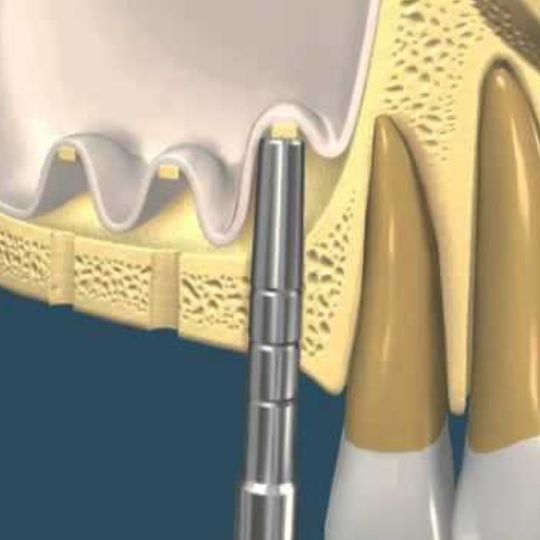 Bone Graft And Sinus Lift - Artista Advanced Dentistry