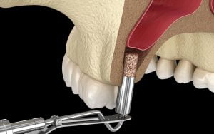 bone graft and sinus lift-cover